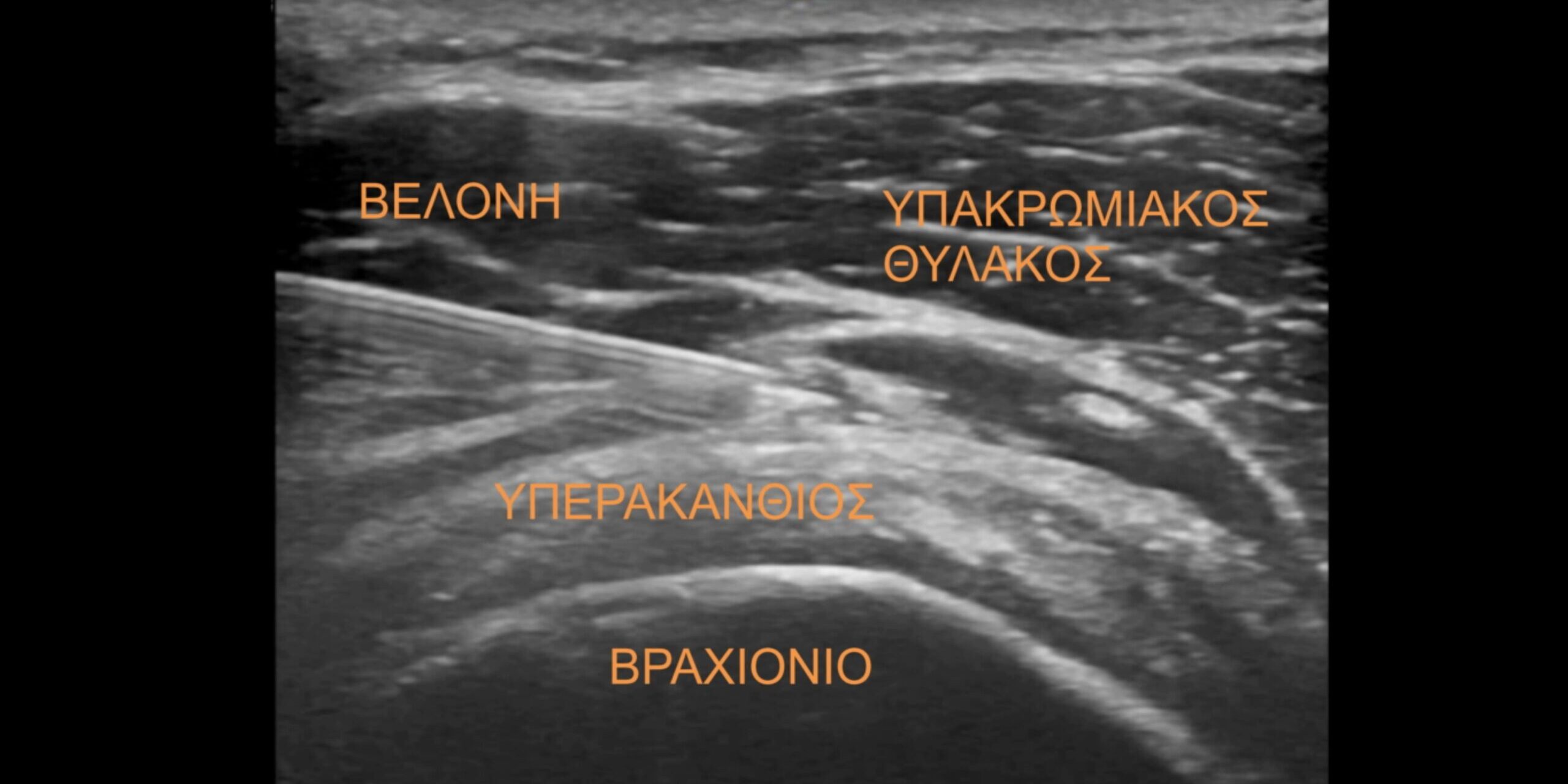 ΥΠΕΡΗΧΟΓΡΑΦΙΚΑ ΚΑΤΕΥΘΥΝΟΜΕΝΗ ΕΓΧΥΣΗ ΥΠΕΡΗΧΟΓΡΑΦΙΚΑ ΚΑΤΕΥΘΥΝΟΜΕΝΗ ΕΓΧΥΣΗ