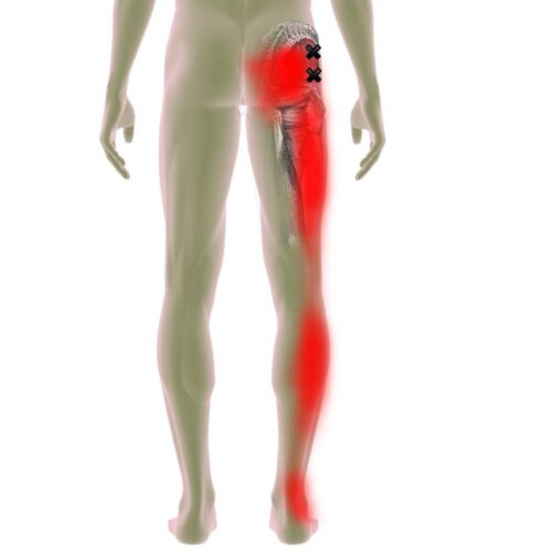 μυοπεριτονιακός πόνος